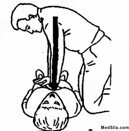 Прямые руки при надавливании на грудину