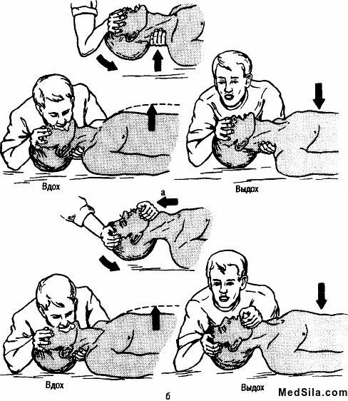 ИВЛ рот в рот